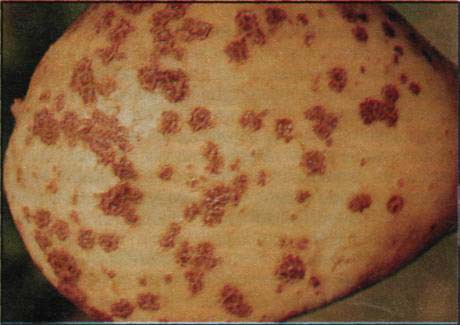 Obecná strupovitost brambor (Streptomyces scabies)